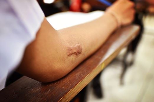 worker with large scar on their arm
